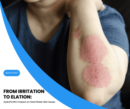 From Irritation to Elation: HydroFLOW’s Impact on Hard Water Skin Issues